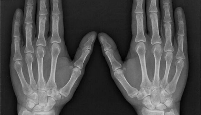 rentgenogrāfija artrīta un artrozes diagnostikai