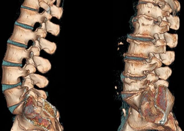 Jostas reģiona osteohondroze
