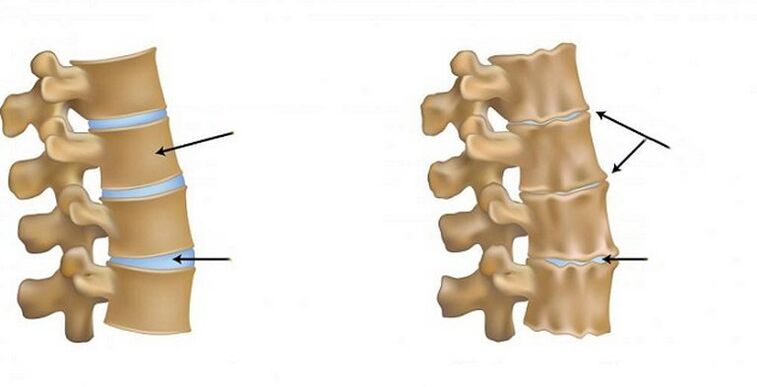 osteohondrozes išēmiskais sindroms