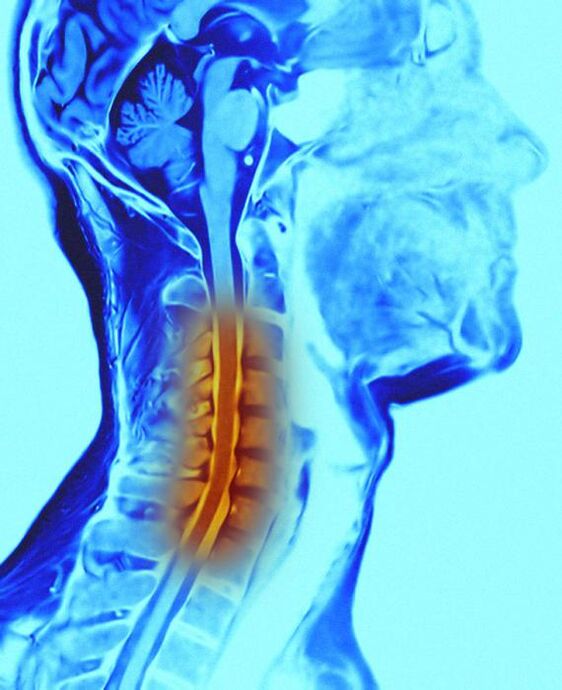 mugurkaula kakla daļas un osteohondroze